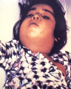 1995 Dr.?? This child with diphtheria presented with a characteristic swollen neck, sometimes referred to as bull neck. Diphtheria is an acute bacterial disease involving primarily the tonsils, pharynx, larynx, nose, skin, and at times other mucous membranes. The mucosal lesion is marked by a patch or patches of an adherent grayish membrane with a surrounding inflammation.