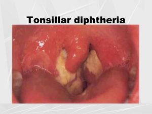 diphtheria-tonsillitis-im-56-638